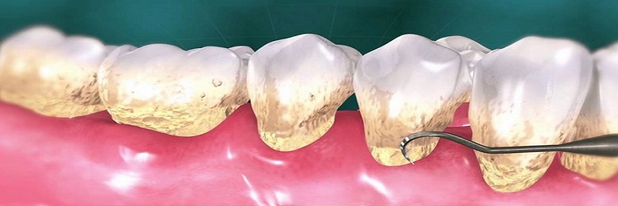 مراقبت‌های پس از جرمگیری دندان