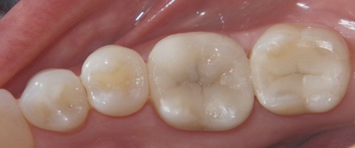 پرکردن دندان ها با کامپوزیت