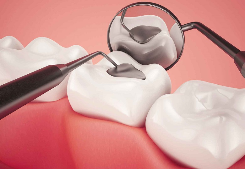 مراقبت های بعد از ترمیم دندان 