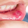 درمان آفت دهان با لیزر