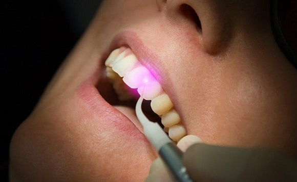 لیرز برای ترمیم درمان پوسیدگی دندان