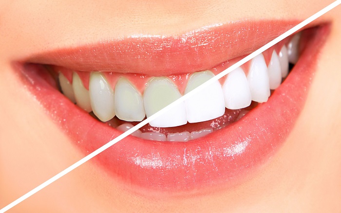 دلایل سفید کردن دندان ها