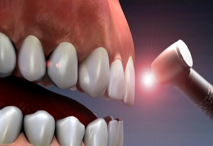 کاربرد لیزر در دندانپزشکی 