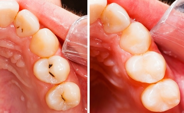 کاربرد لیزرها در پر کردن دندان ها