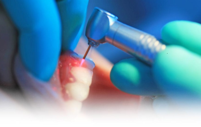 مزایا و معایب استفاده از لیزر در دندانپزشکی
